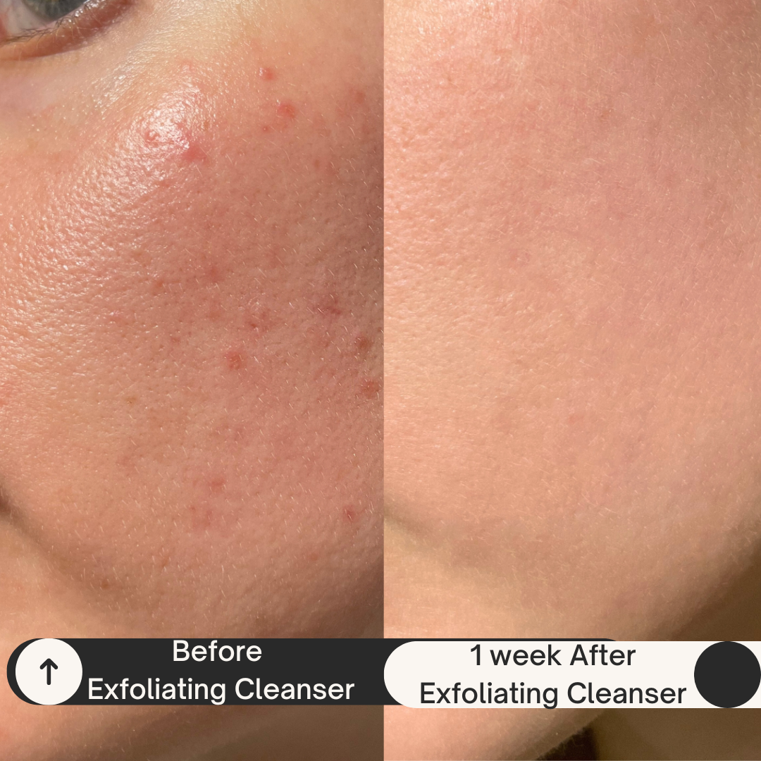 Before-and-after photo of cheek using Covenance Beauty Brighter Complexion Exfoliating Gel Cleanser: left side shows red acne bumps and uneven texture; right side, after 1 week, reveals smoother, clearer skin. Highlights gentle jojoba bead + glycolic exfoliation for sensitive, acne-prone skin.