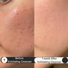 Before-and-after photo of cheek using Covenance Beauty Brighter Complexion Exfoliating Gel Cleanser: left side shows red acne bumps and uneven texture; right side, after 1 week, reveals smoother, clearer skin. Highlights gentle jojoba bead + glycolic exfoliation for sensitive, acne-prone skin.